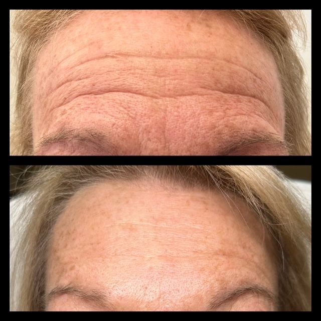 A before and after picture of a woman 's forehead with wrinkles.