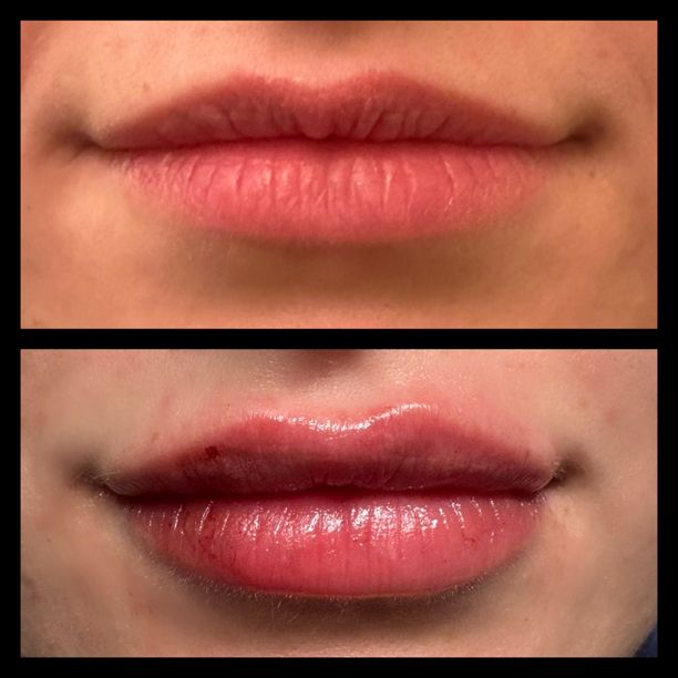 A before and after picture of a woman 's lips.