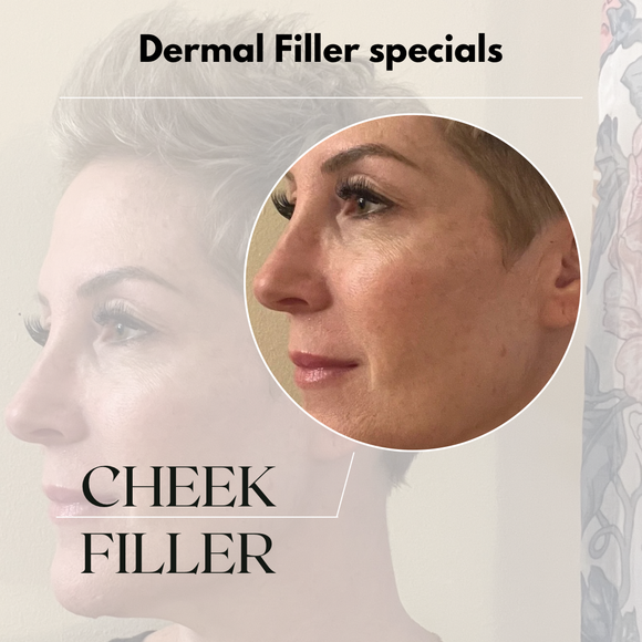 A picture of a woman's face with the words dermal filler specials cheek filler