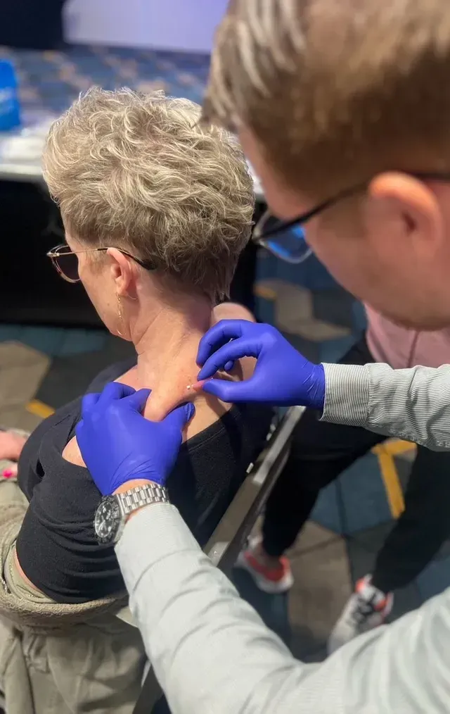 Polydioxanone threads treatment