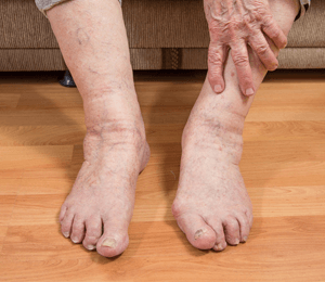 Feet deformities