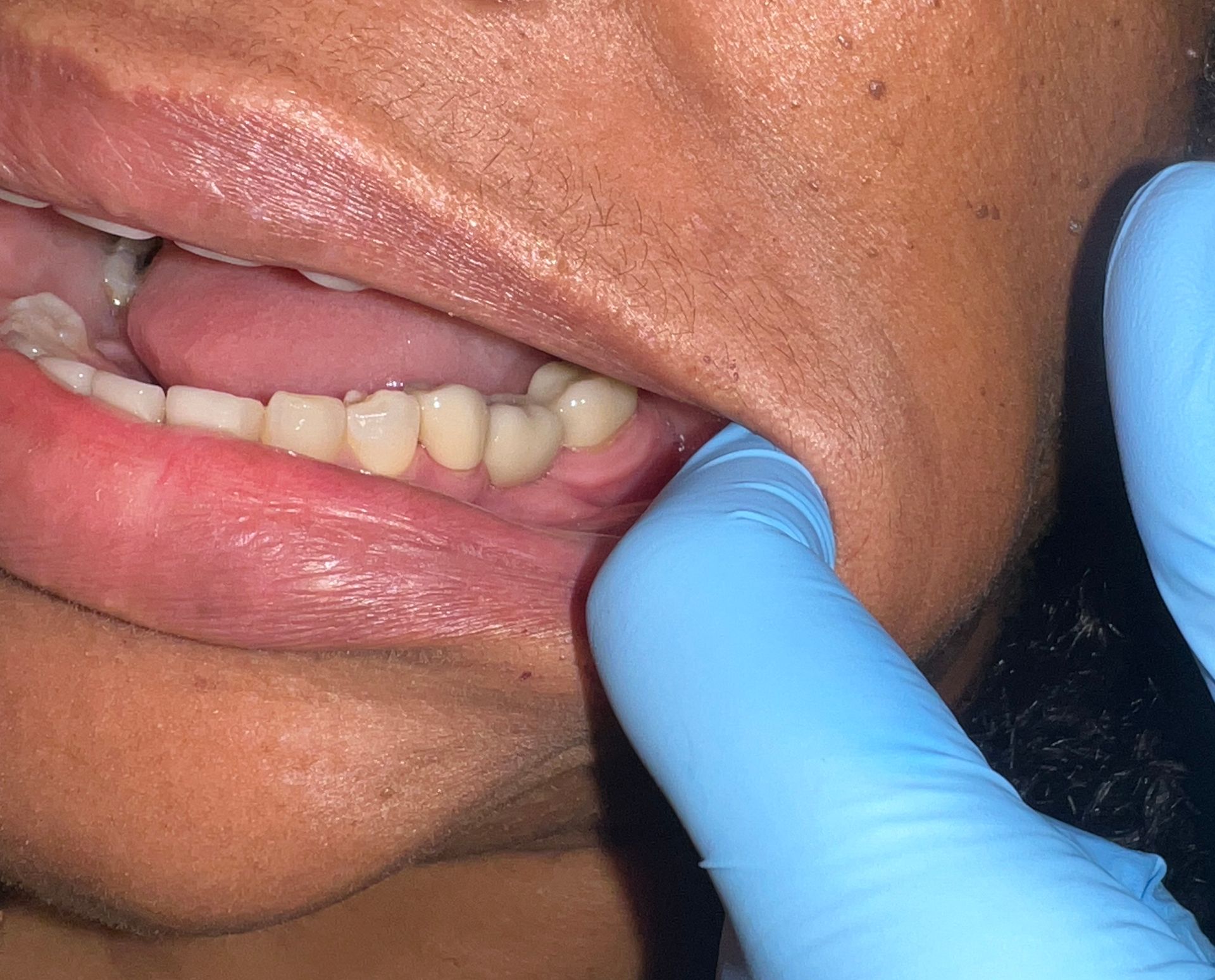 A close up of a person 's mouth with a blue glove on