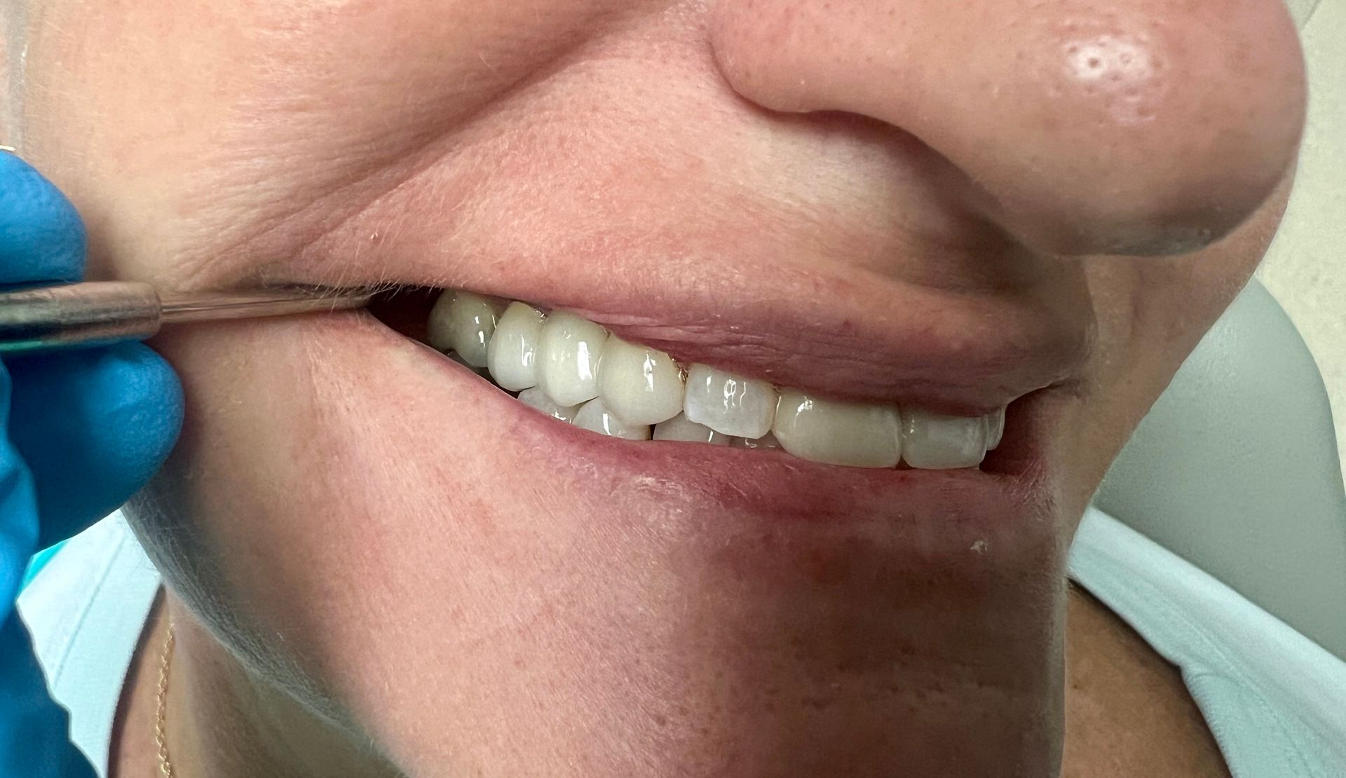 A woman is getting her teeth examined by a dentist.
