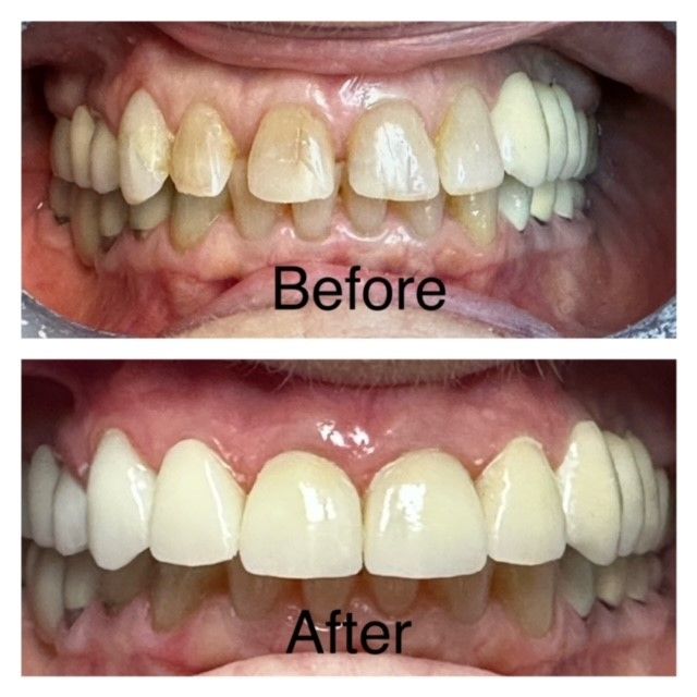A before and after picture of a person 's teeth.