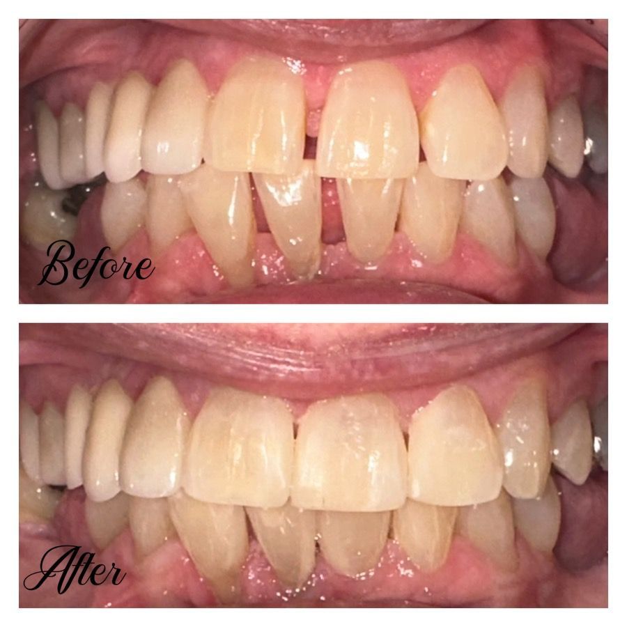 A before and after picture of a person 's teeth.