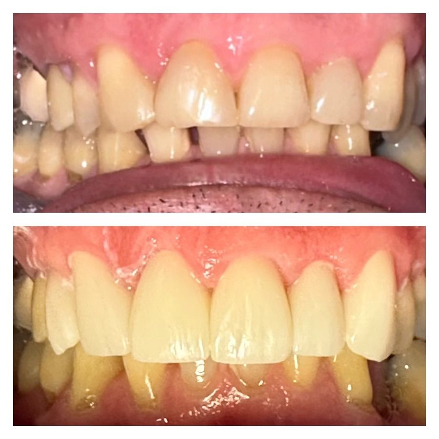 A before and after picture of a person 's teeth.