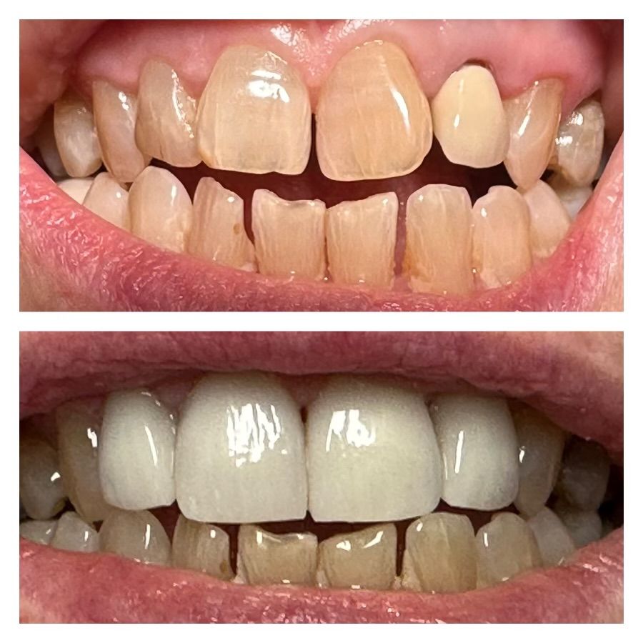 A before and after picture of a person 's teeth.