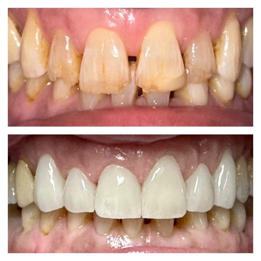 A before and after picture of a person 's teeth.