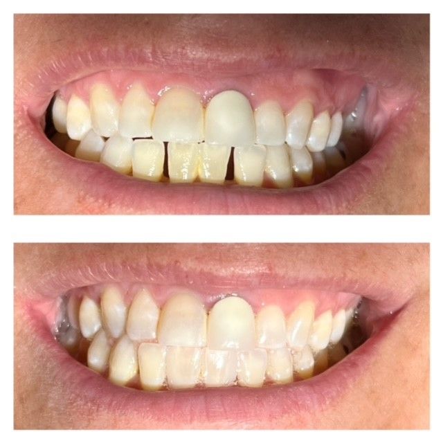 A before and after picture of a person 's teeth.