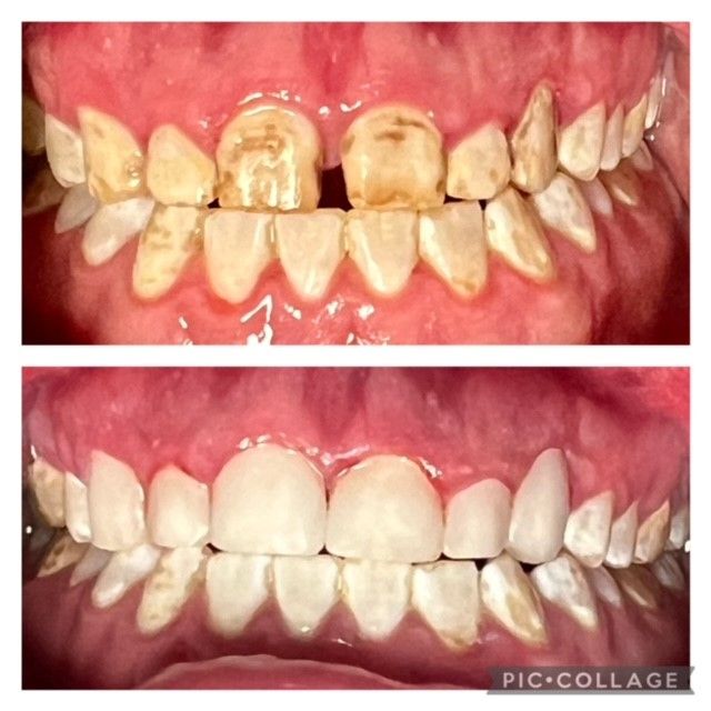A before and after picture of a person 's teeth.