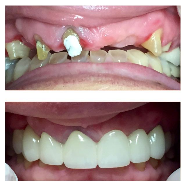 A before and after picture of a person 's teeth
