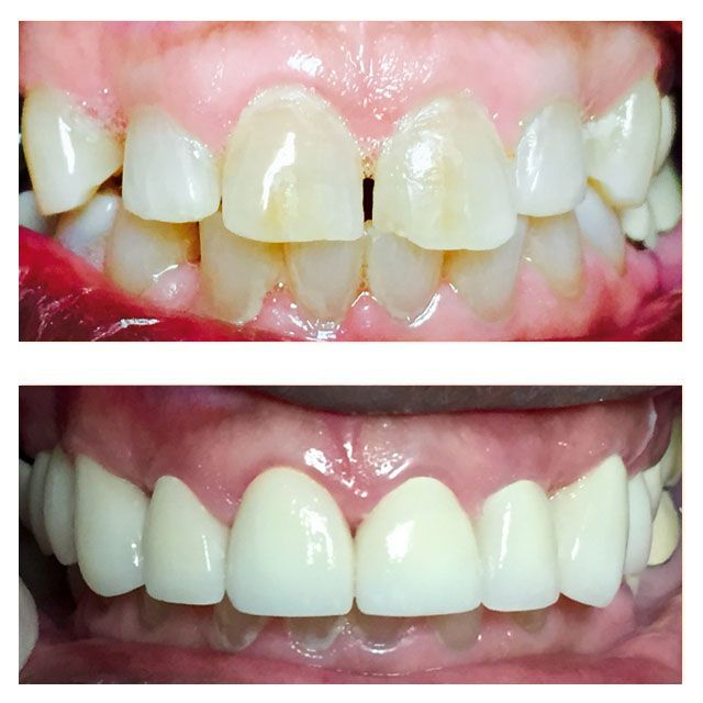 A before and after picture of a person 's teeth