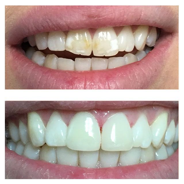 A before and after picture of a person 's teeth