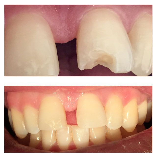 A before and after picture of a person 's teeth.