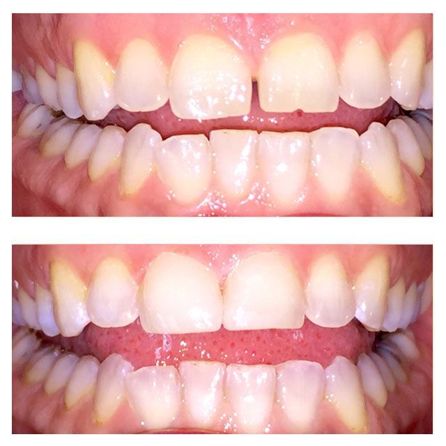 A before and after picture of a person 's teeth