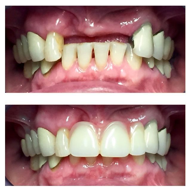 A before and after picture of a person 's teeth