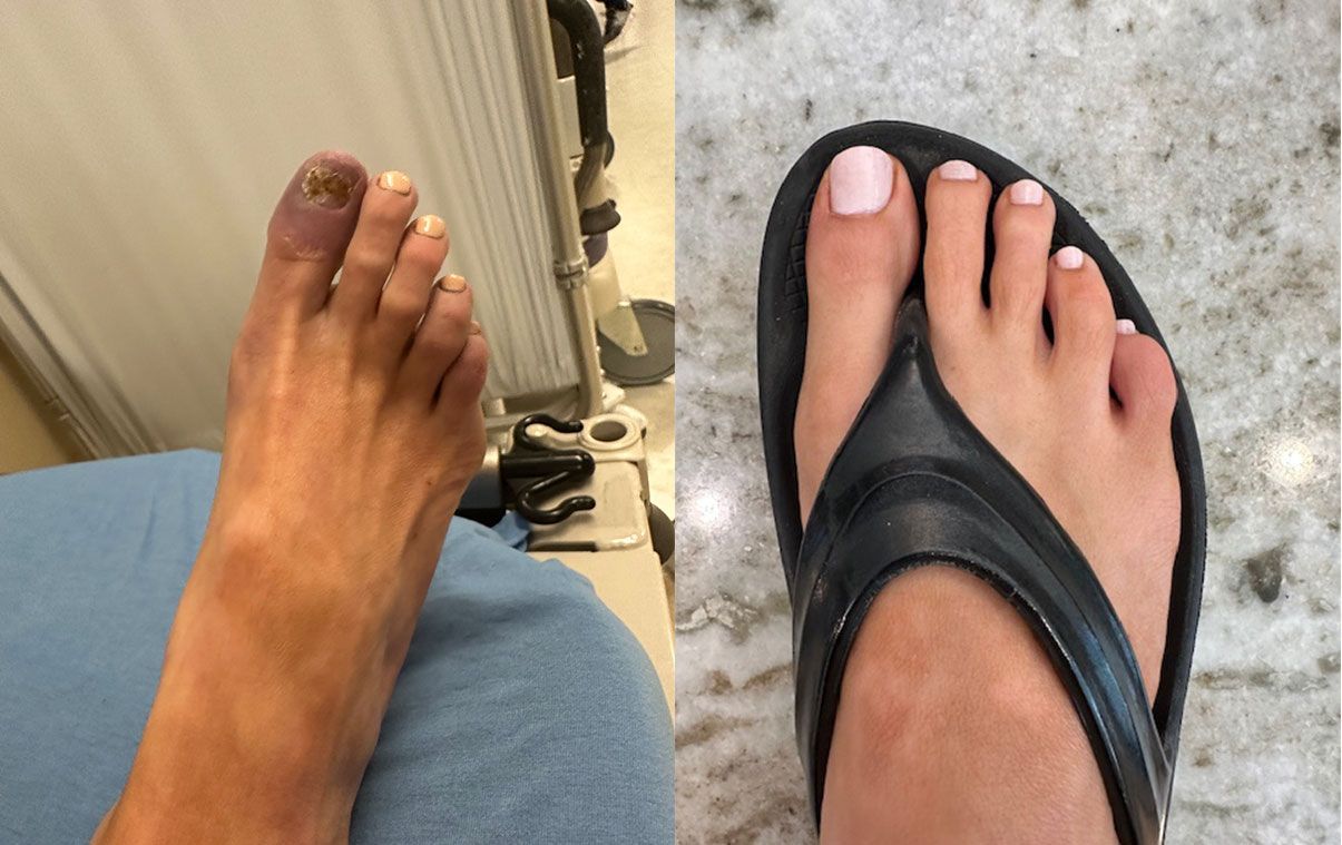 A foot with a bruised and discolored toe next to a foot with painted toenails in a sandal.