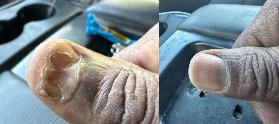 Thumb with a blister and a healed thumb.