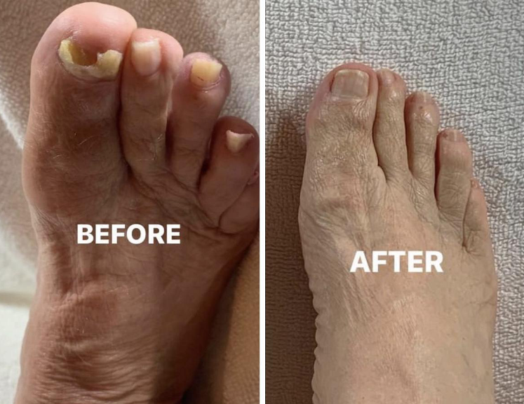 Foot with fungal toenails before and after treatment.