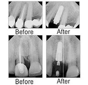 before and After Dental Implants