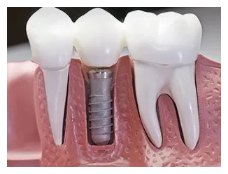 Dental implants