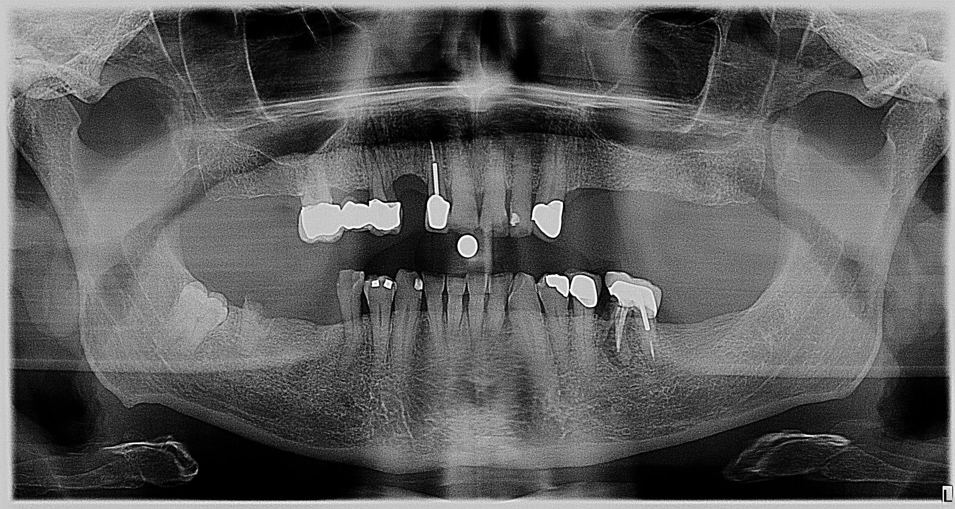 Beginning Implant
