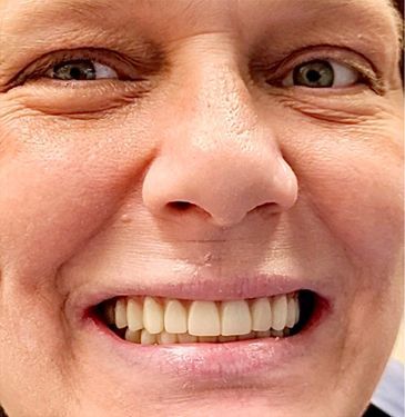 Implants and the hybridge prosthetic