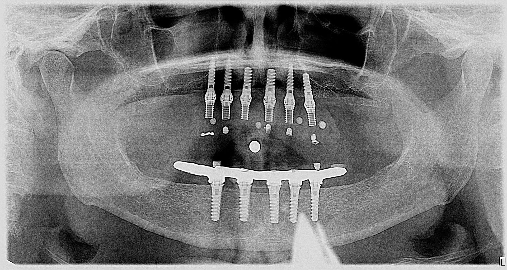 A black and white x-ray of a person's mouth with dental implants