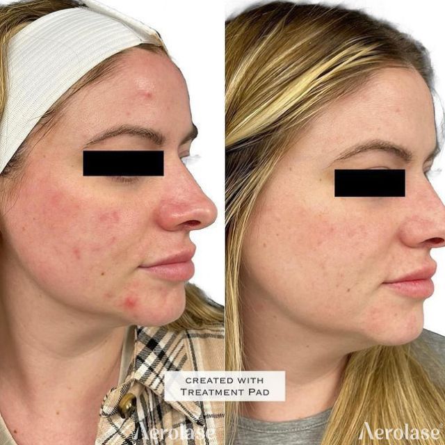 Before and after comparison showing reduced facial acne and skin inflammation after an Aerolase laser treatment.