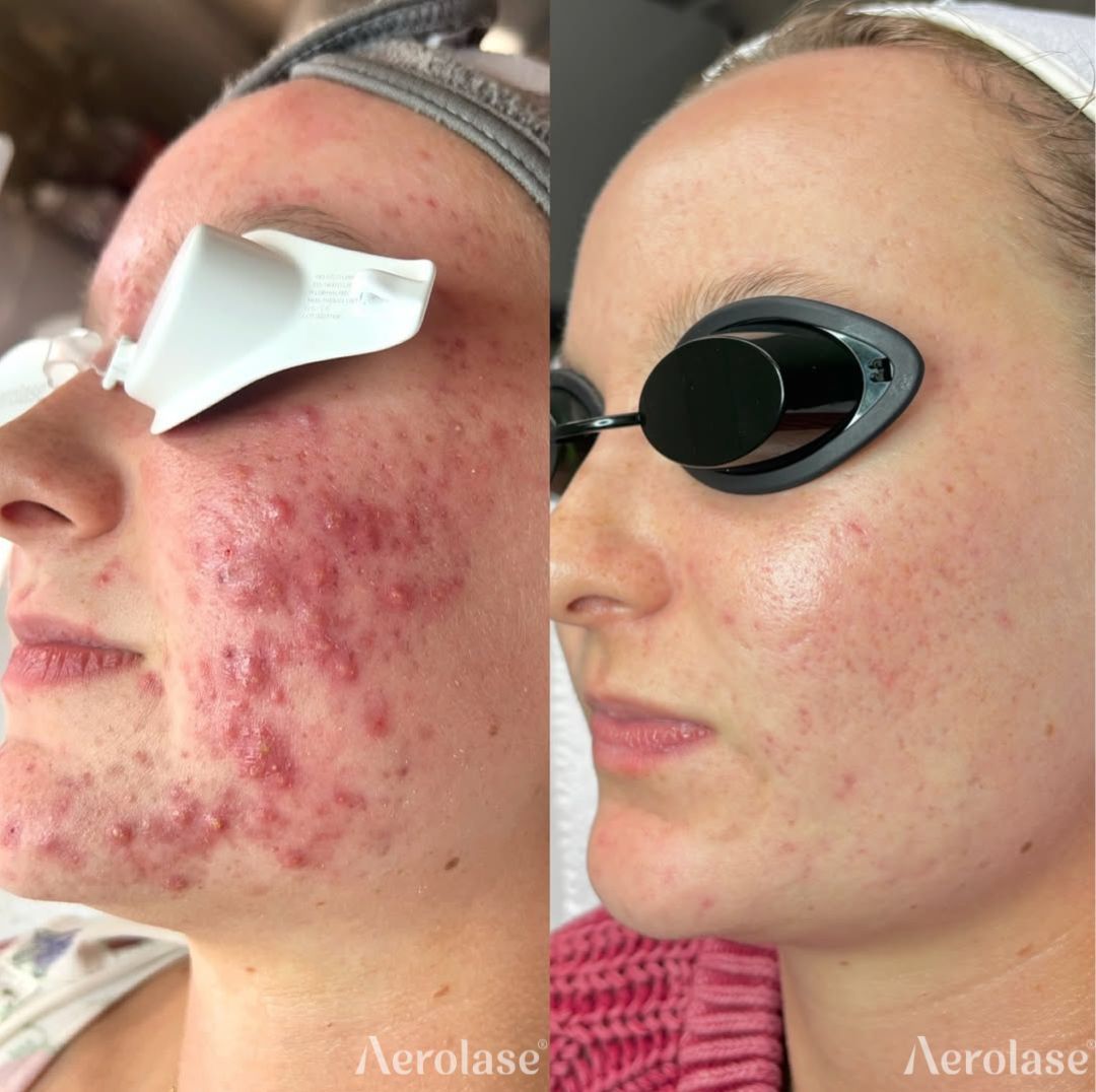 Before and after comparison of a person's skin, showing a significant reduction in acne and redness after laser treatment.