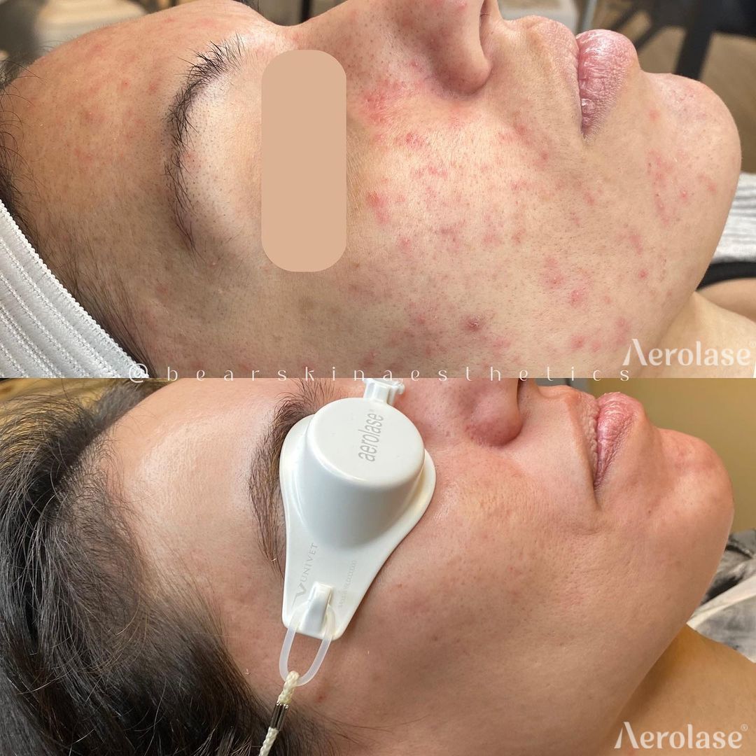Before and after comparison of a person's cheek showing a reduction in redness and skin irritation after laser treatment.