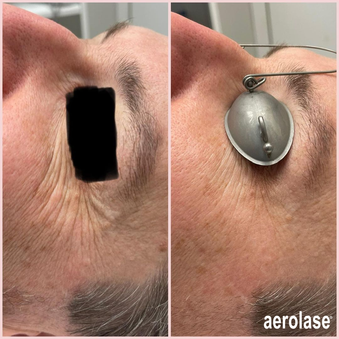 A side-by-side comparison of a person's eye area, with a protective metal eye shield placed over one eye for a laser procedure.