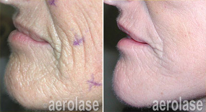 Before and after photos showing reduced wrinkles around the mouth and chin following an Aerolase laser treatment.