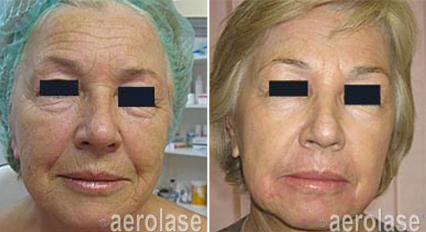 Before-and-after comparison of a face showing reduced wrinkles and improved skin texture after laser treatment.