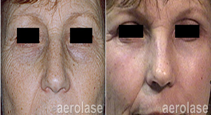 Before and after comparison of a patient’s face showing reduced skin wrinkles and improved texture after laser treatment.