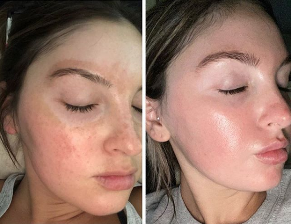 Before and after comparison showing a decrease in skin discoloration and redness on a person's face.