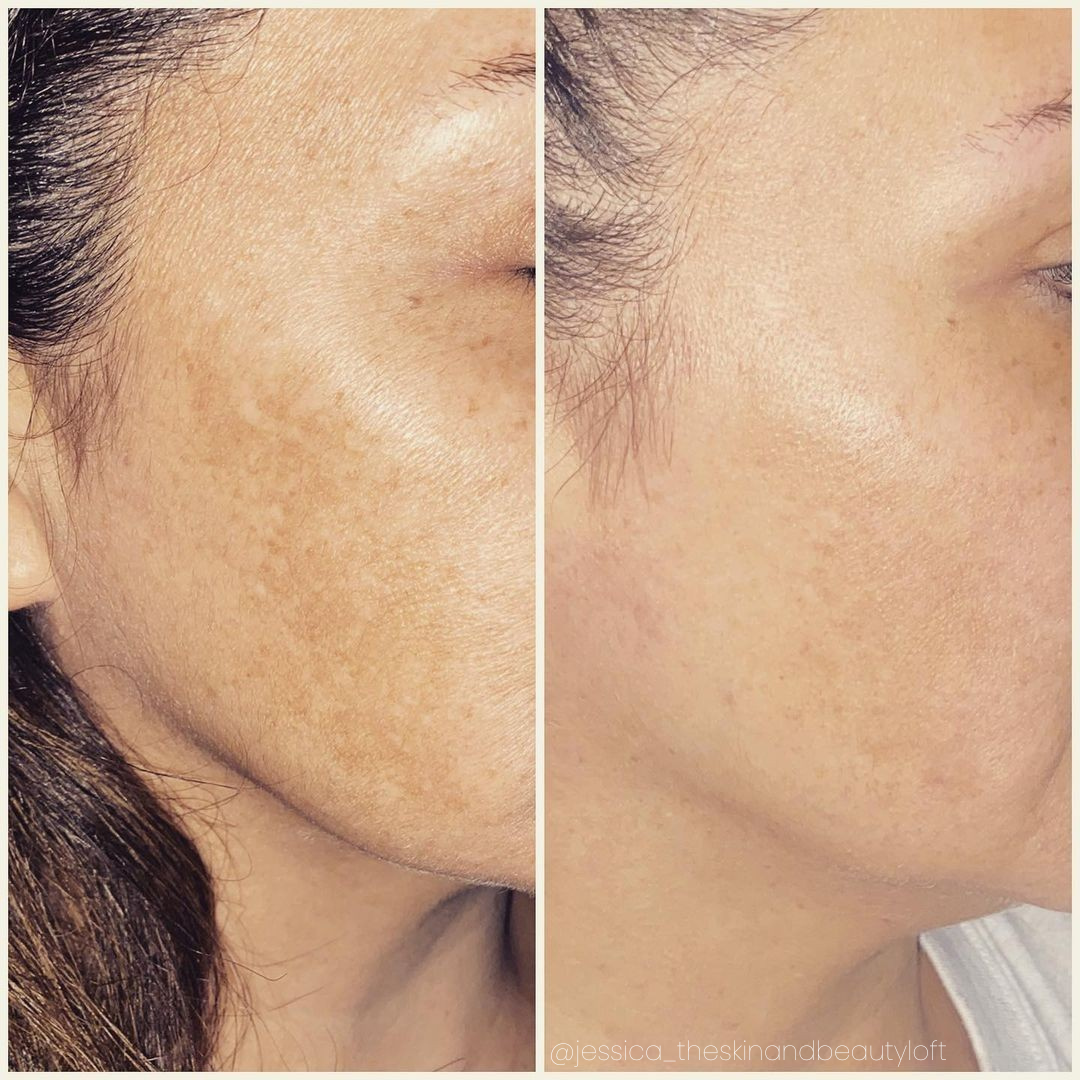 Before-and-after comparison of a person's cheek showing a reduction in skin hyperpigmentation and improved skin tone.