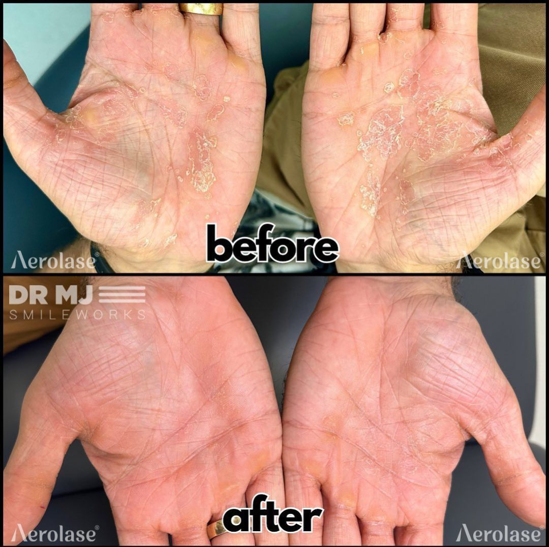 Before and after comparison of palms showing clear improvement in skin texture and irritation after dermatological treatment.
