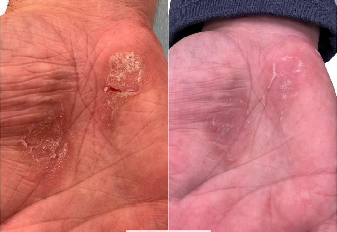 A side-by-side comparison of a human palm showing dry, scaly skin patches before and after treatment.