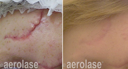 Before and after comparison of a surgical scar on skin treated with Aerolase laser technology, showing improved appearance.