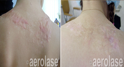 Before and after comparison of treatment on raised, red back scars showing reduction in redness and scar thickness.
