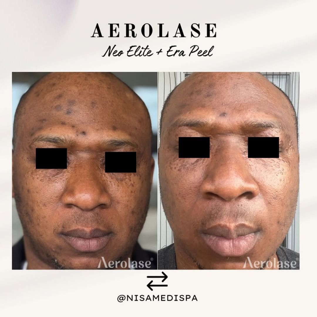 Before-and-after comparison of a person's face treated with Aerolase Neo Elite and Era Peel for skin resurfacing.