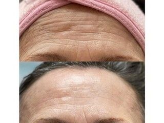 Before-and-after comparison of a forehead, showing a reduction in the depth and visibility of horizontal skin wrinkles.