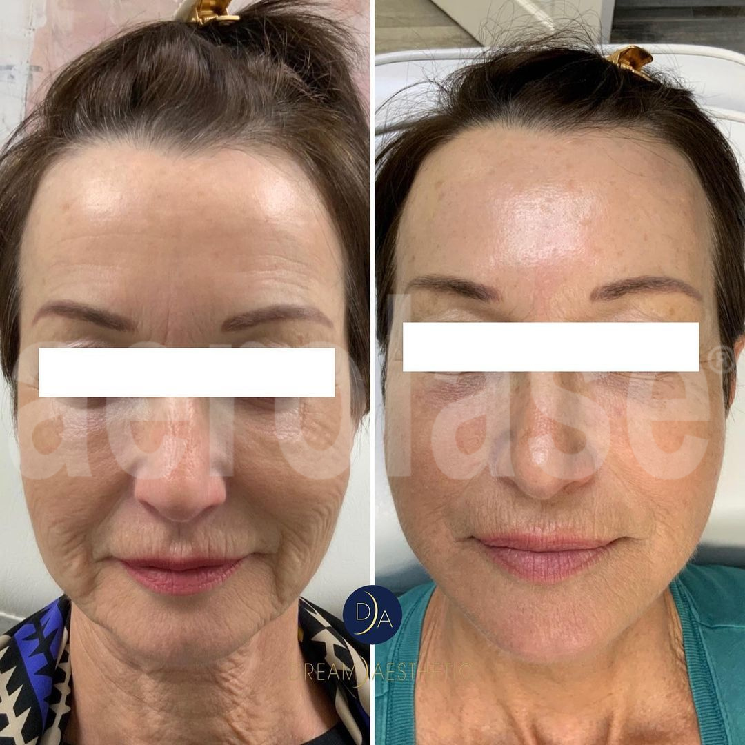 Before and after comparison of a person's face, showing reduced skin texture and fine lines after a cosmetic treatment.