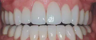 Close-up of closed white teeth and pink gums in a bright smile