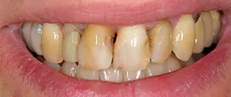 Close-up of a smiling mouth with yellowed teeth and minor discoloration