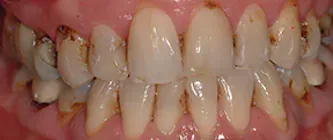 Close-up of teeth with visible yellow-brown staining and tartar buildup along the gums