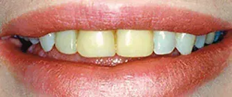 Close-up of a smile showing yellowed teeth and lips