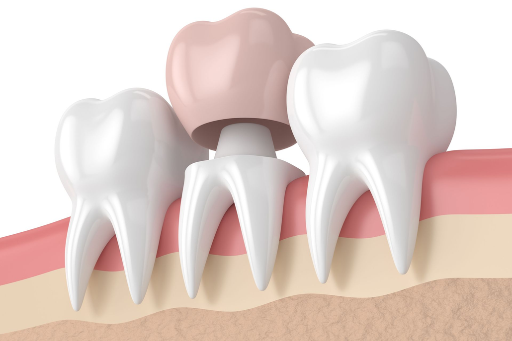 Illustration of a dental crown on a tooth between two white teeth and pink gums