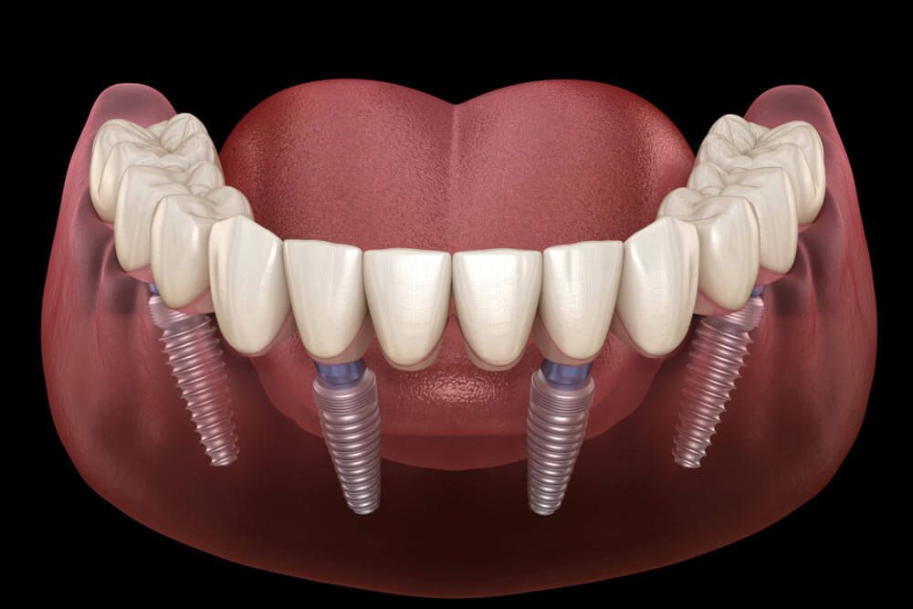 Dental implant with denture